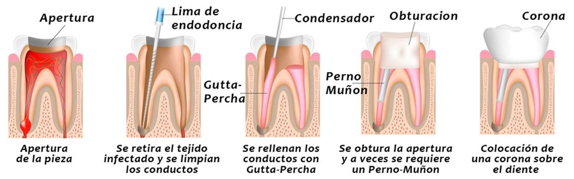 Centro Dental Roberto Cristóbal diente por dentro
